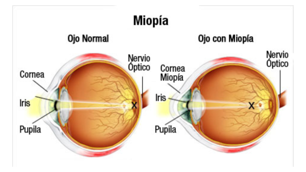 Centre Optic del Bages - Óptica, Optometria i audiologia | ¡Explorando la Miopía! Todo lo que necesitas saber.